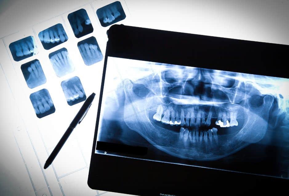 ☢️ FMX Dental X-ray Guide (Are They Safe?)