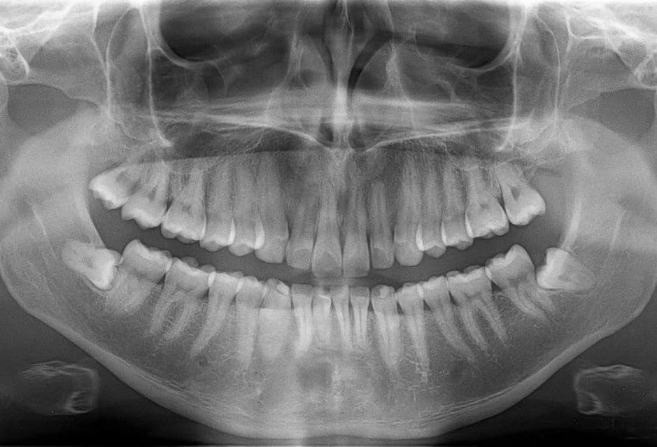 Transforming Dental Health: The Breakthrough of Digital Dental X-rays | My Dental Advocate