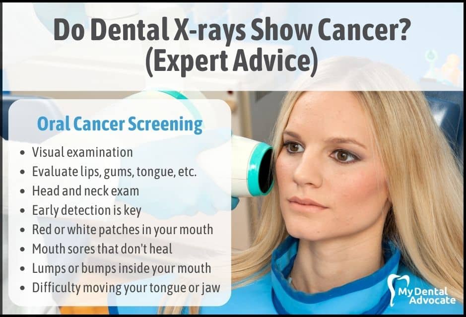 Do Dental X-rays Show Cancer? (Expert Advice) | My Dental Advocate