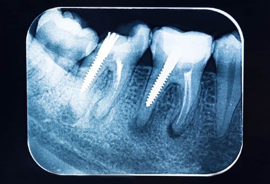 ☢️ FMX Dental X-ray Guide (Are They Safe?)