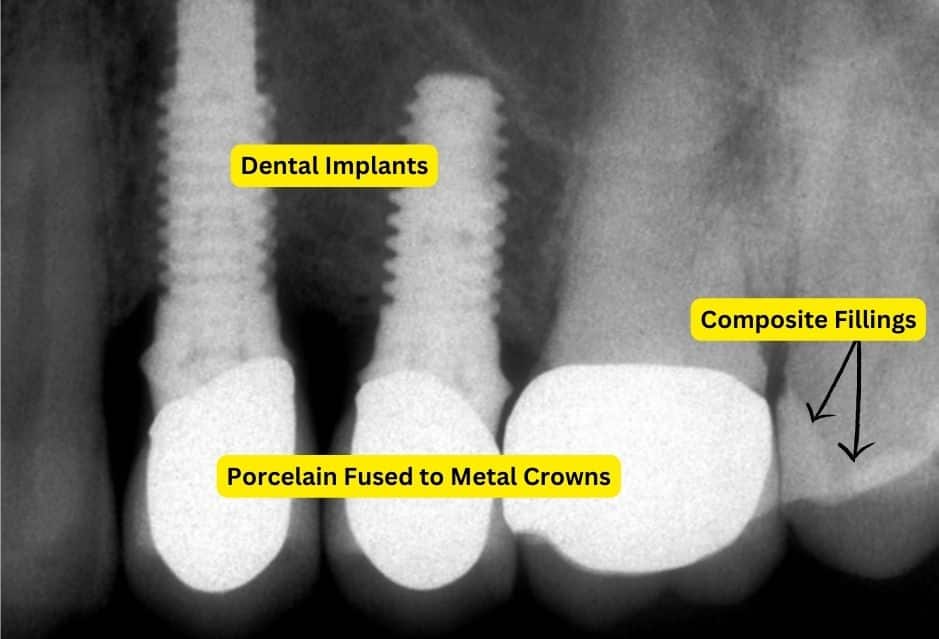 White Spot on Dental X-Ray: Causes and Treatment Options | My Dental Advocate