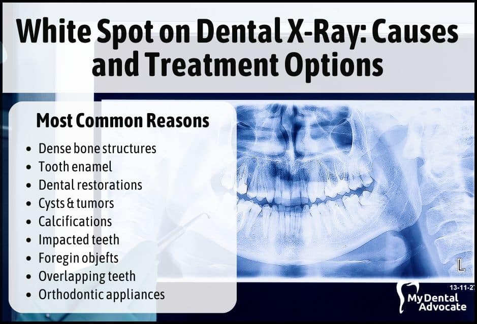 White Spot on Dental X-Ray: Causes and Treatment Options | My Dental Advocate