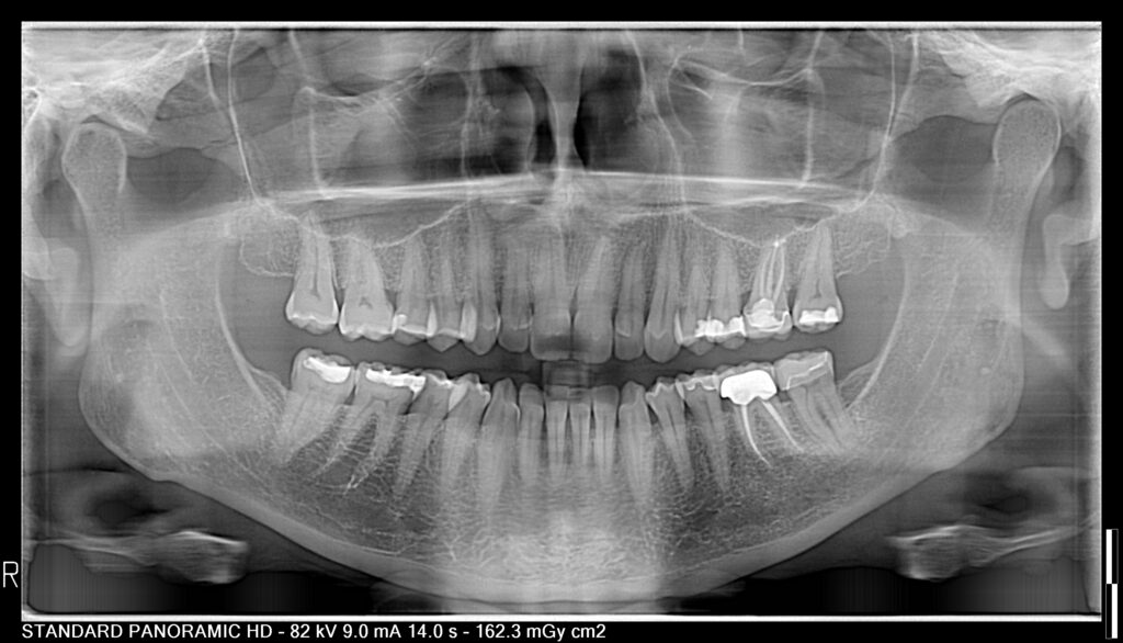 Joy-pan-7-1-24 | My Dental Advocate panoramic x-ray